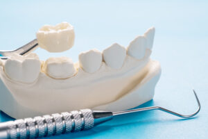 Corone dentali generate dall'intelligenza artificiale