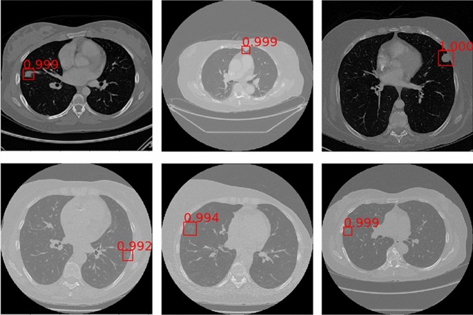 AI Lungcancer