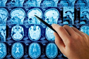 Опухоль мозга с искусственным интеллектом